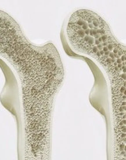 Osteoporosis 4 Stages -- 3D Rendering