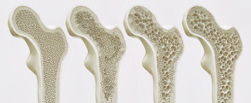 Osteoporosis 4 Stages - 3D Rendering
