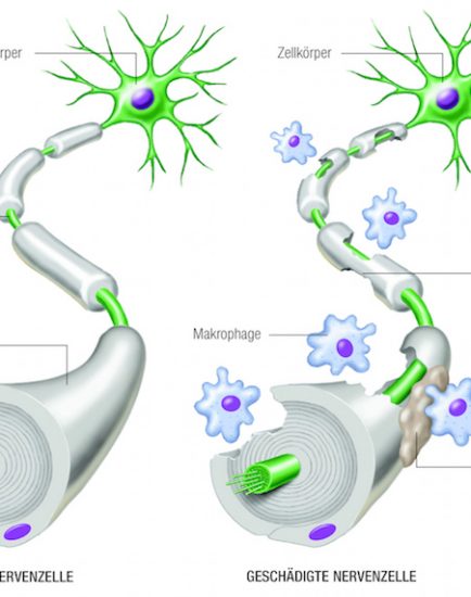gesunde und kranke Nervenzelle