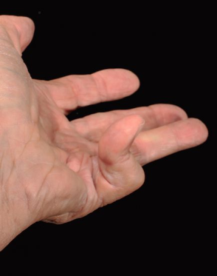 Dupuytren's Contracture