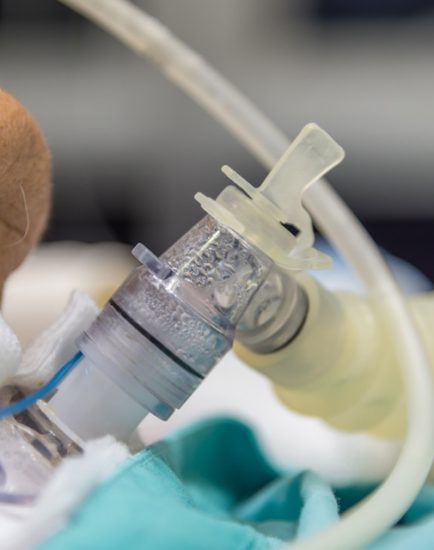 Patient do tracheostomy and ventilator in hospital