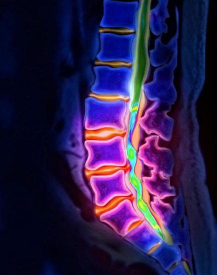 Bandscheibenvorfall, Lendenwirbel, Computertomographie